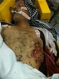 Bahrain 2011 február sebesültek-söréttel